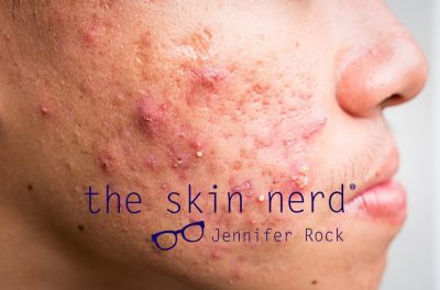 Cysta, Cysta: Cystic Acne Vs. Other Grades of Acne