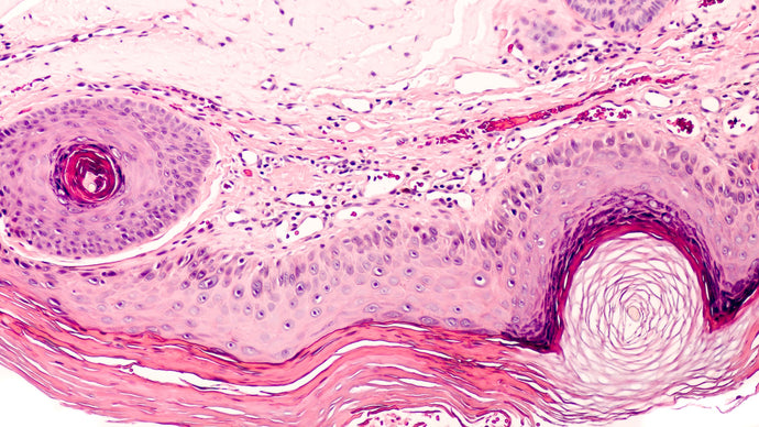 What you need to know about... Actinic Keratosis