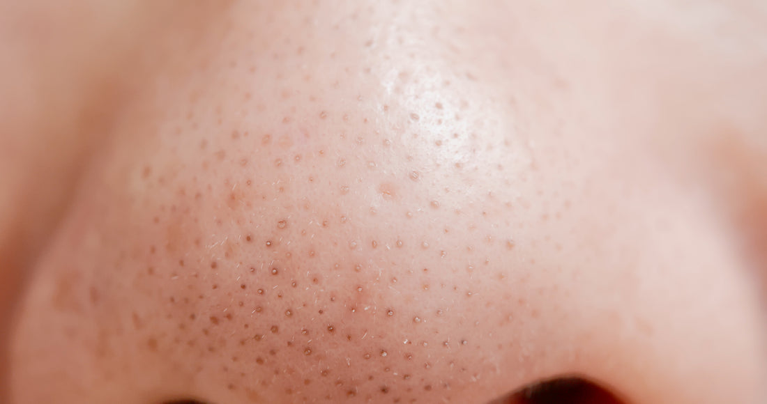 What Are They & How Do You Remove Them?