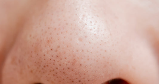 What Are They & How Do You Remove Them?