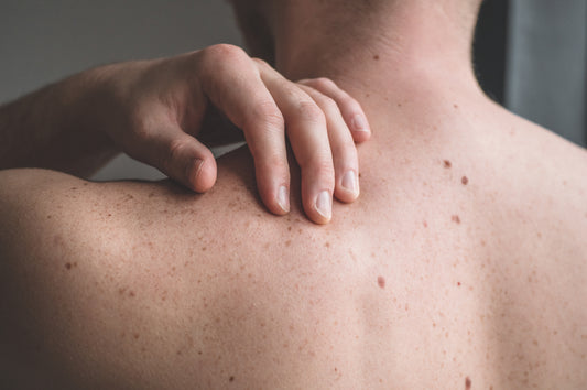 A Nerdie Guide to Moles & Sun Safety