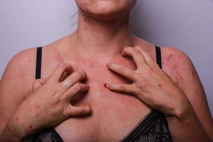 The Derms guide to eczema