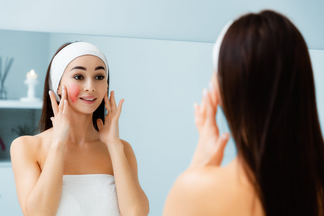 Taking care of rosacea-prone skin at home