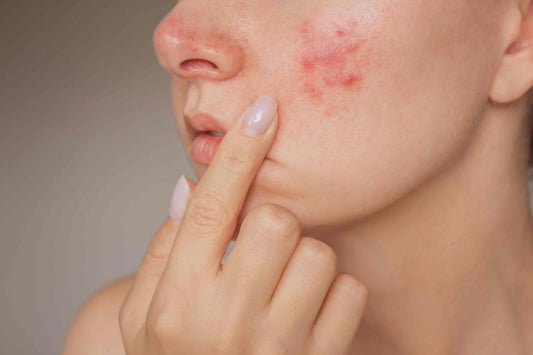 rosacea