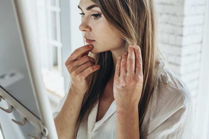 Psoriasis – what it is and how to manage it