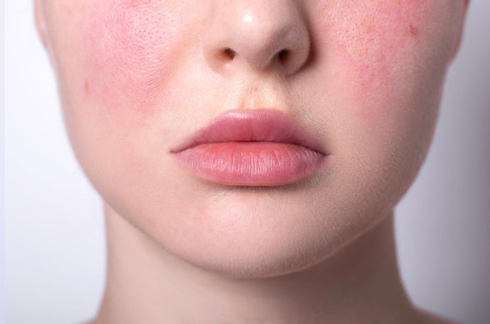 Rosacea Awareness Month: Getting to know the causes, types & symptoms
