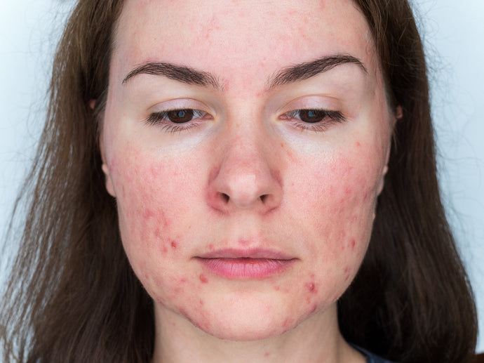 Is it acne or rosacea?
