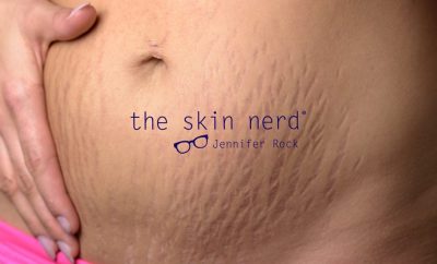 Stretch Marks: Minimising The Tiger Stripes