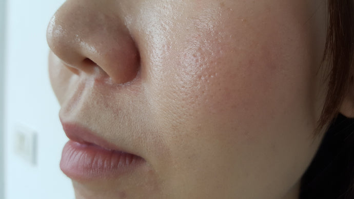 Large Pores: Why They Happen And What To Do