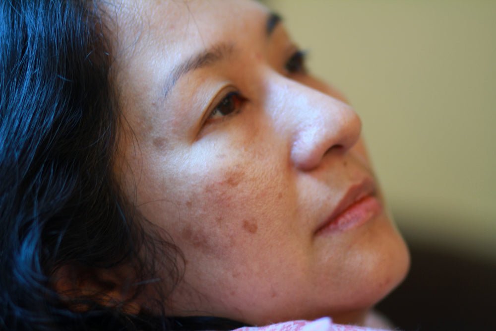 tackling skin pigmentation