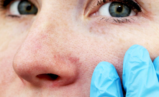 Broken Blood Vessels - How To Prevent And Treat Them
