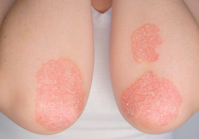 World Psoriasis Day Q&A with Dr. Olga